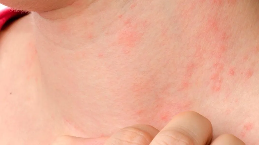 Que es el lupus tu reumatologa pediatra